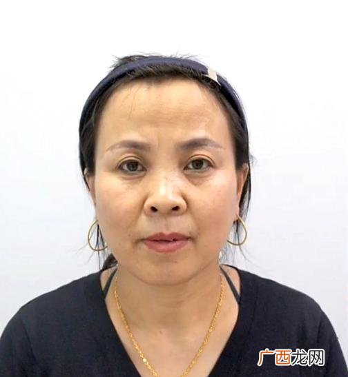 面部提升哪个效果好 现在做什么美容项目可以提升