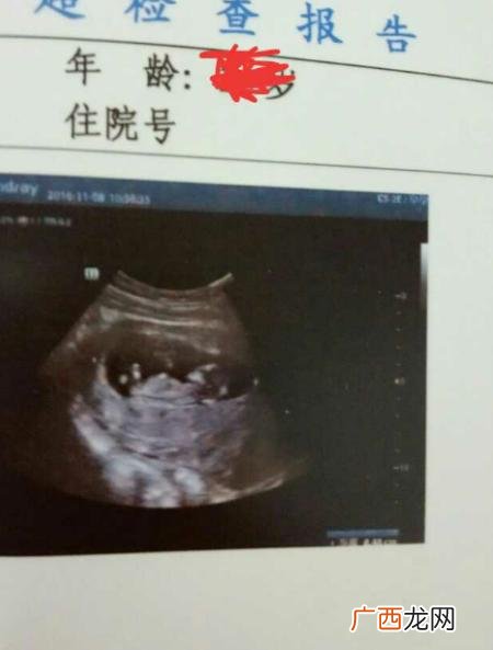 12周做nt医生说孩子小,小周医生说