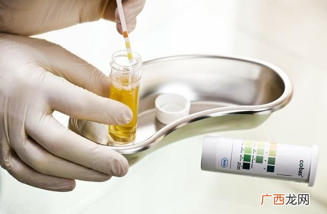 女性尿检报告单怎么看 尿常规各项的正常值范围