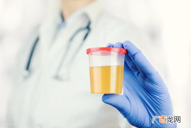 女性尿检报告单怎么看 尿常规各项的正常值范围