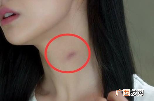 种草莓是什么意思 种草莓的技巧该怎么吸 种草莓的吻痕图片