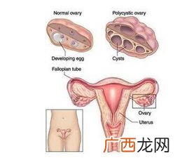 卵巢多囊是什么意思,什么叫多囊？