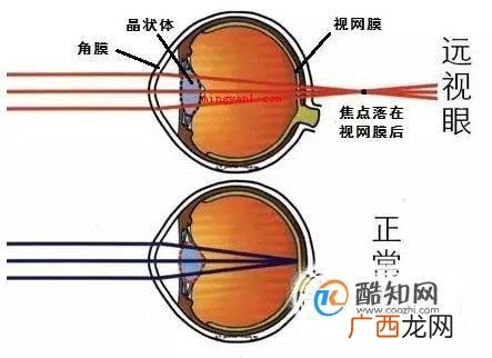 视力4.5是多少度