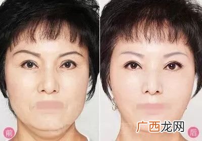 胶原蛋白填充脸部危害,阿尔法胶原蛋白填充粉正规吗?