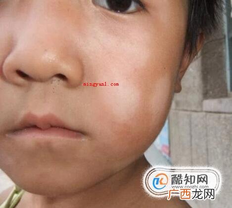 白斑初期症状图片小孩