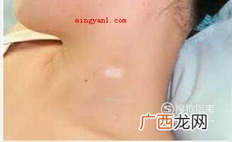 白斑初期症状图片小孩