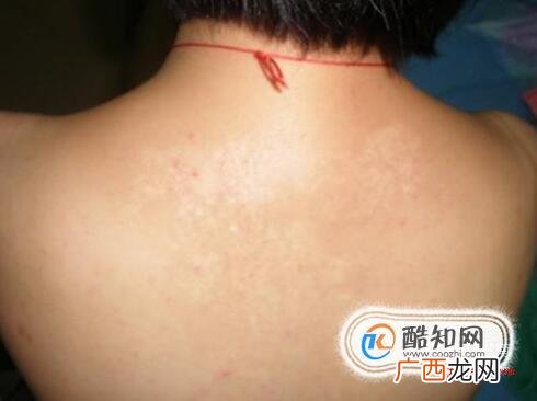 白斑初期症状图片小孩