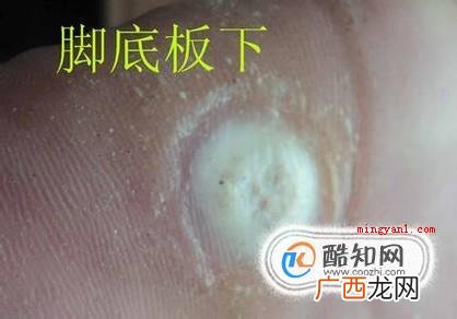 肉刺长什么样子，脚上肉刺图片