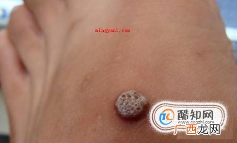 肉刺长什么样子，脚上肉刺图片