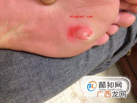 肉刺长什么样子，脚上肉刺图片