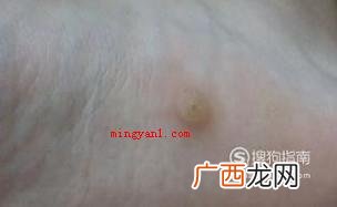 肉刺长什么样子，脚上肉刺图片
