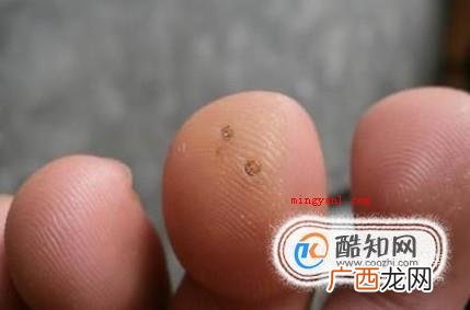 肉刺长什么样子，脚上肉刺图片