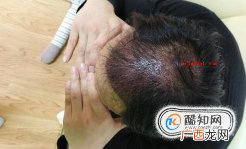 毛囊炎初期症状和图片