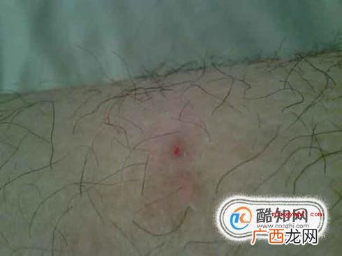 毛囊炎初期症状和图片