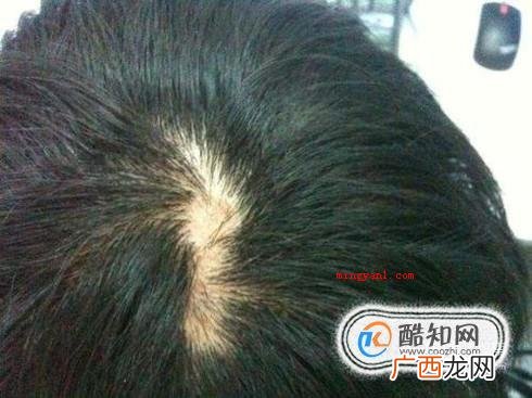 毛囊炎初期症状和图片
