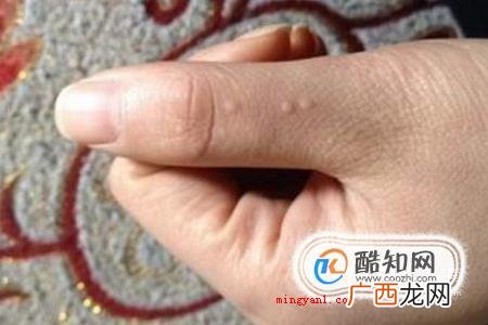 扁平疣长什么样子，扁平疣图片