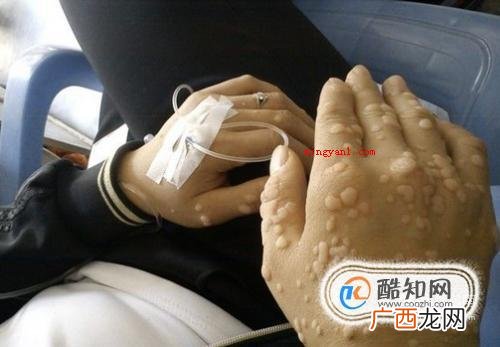 扁平疣长什么样子，扁平疣图片
