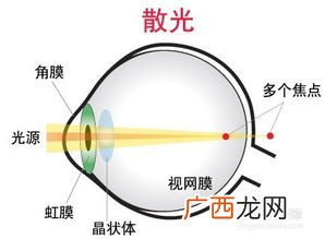 眼睛散光是什么意思,散光是什么？