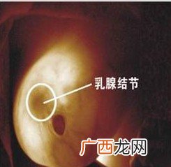 乳腺结节有几种类型,乳腺结节级别划分标准？