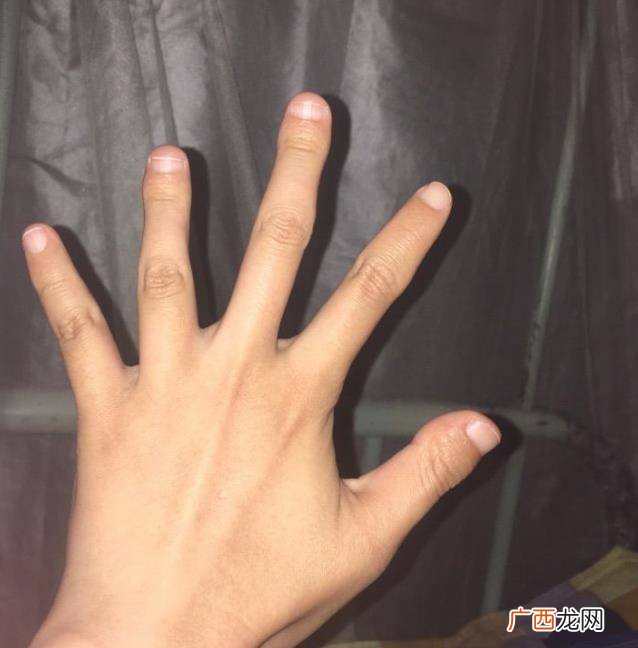 为什么有的人大拇指指甲非常短,我的大拇指又短又粗又扁，整个形状呈蛇头状，有什么古老说法吗? 我总是不愿意让别人看到，怕被别人嘲笑？