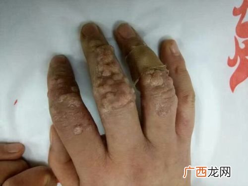 什么是病毒疣,病毒疣用什么药膏擦，去疣灵效果比较好？