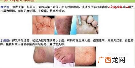 大伙儿了解足癣有哪些吗? 足癣图片大全