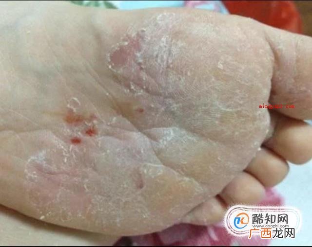 大伙儿了解足癣有哪些吗? 足癣图片大全