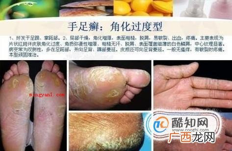 大伙儿了解足癣有哪些吗? 足癣图片大全