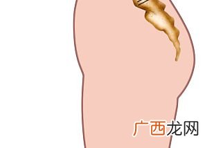 溜肩怎么矫正,溜肩是什么意思？
