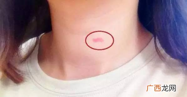 怎样吸草莓吻痕,种草莓印怎么种？