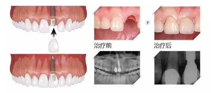 什么叫种牙,种牙怎么种植？