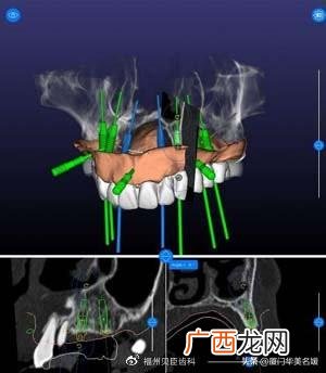 什么叫种牙,种牙怎么种植？