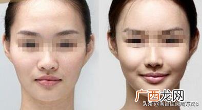 苹果肌填充的方法,自体脂肪填充苹果肌如何？
