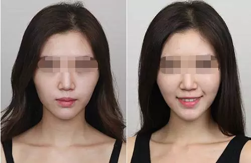 苹果肌填充的方法,自体脂肪填充苹果肌如何？