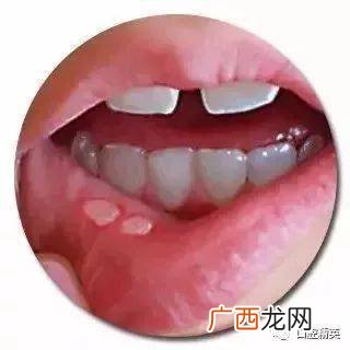 口腔溃疡吃维生素b几,口腔溃疡用B2可以吗？