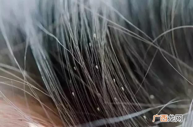 虱子怎么去除,刮虱子的正确方法？