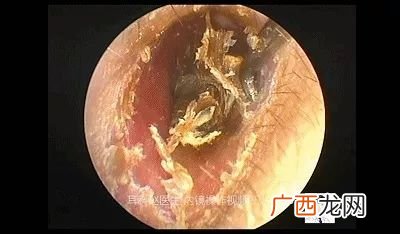 怎么掏耳屎,不用掏耳勺怎么把耳屎弄出来？
