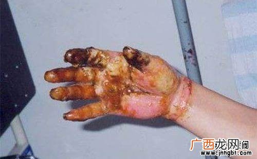 浓硫酸不慎溅到皮肤,不小心接触到硫酸应做哪些应急处理？