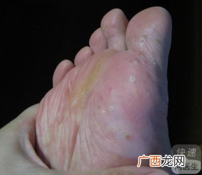 什么叫香港脚,香港脚人什么意思？