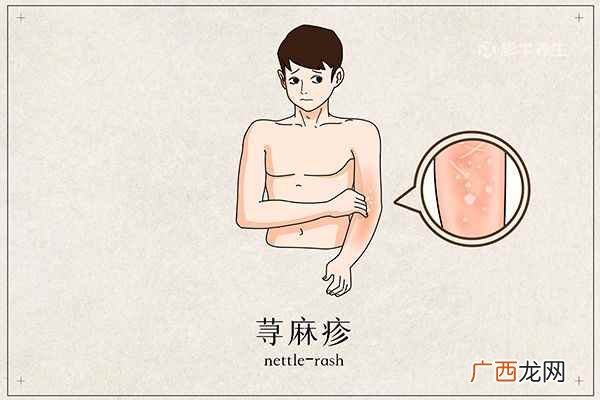 荨麻疹的早期症状有哪些 荨麻疹初期症状图片