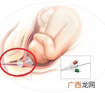球囊催产的原理,热气球原理动画图？