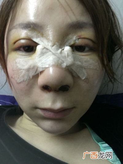 为什么鼻子会变大呢,鼻孔变大是什么原因？