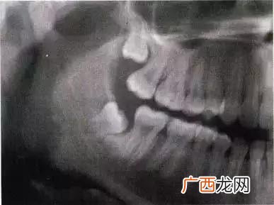 上颌窦在什么地方,上颌是哪里？