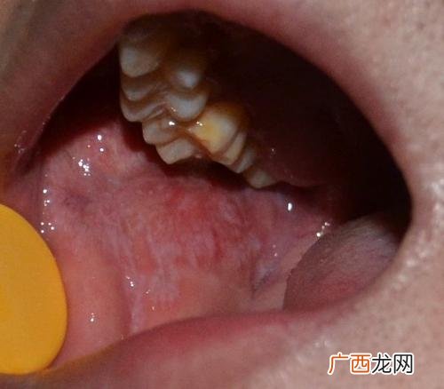 口腔黏膜是什么,口腔黏膜脱落的原因是什么？