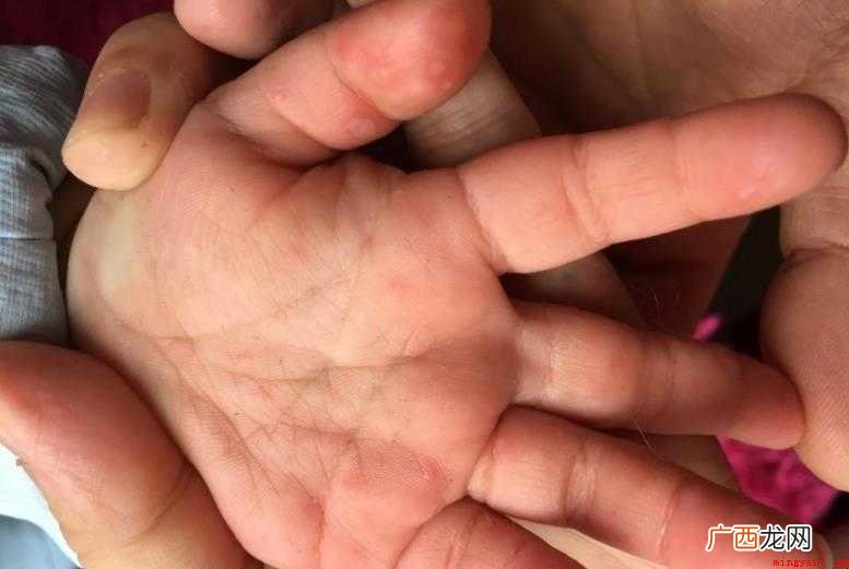 打了手足口疫苗后得了手机足口怎么办 打了手足口疫苗后得了手足口怎么办