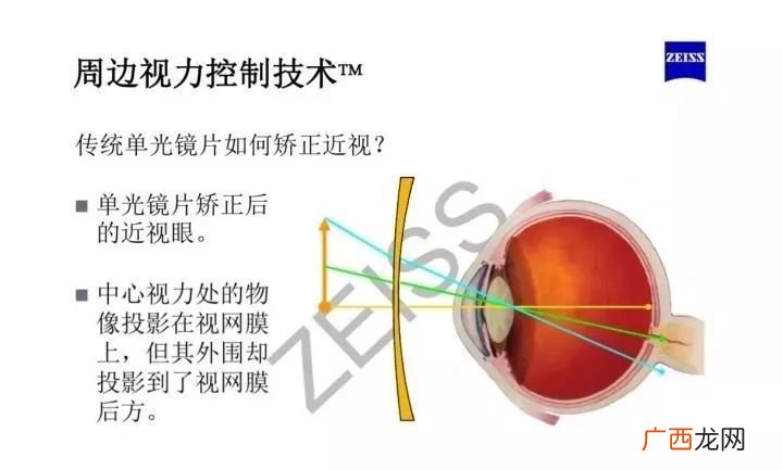 离焦镜片和普通镜片的眼镜的区别,贝壳离焦与普通离焦的区别？