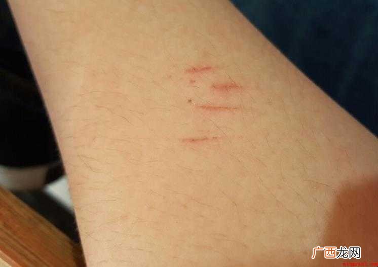 被打了疫苗的猫抓伤需要打针吗