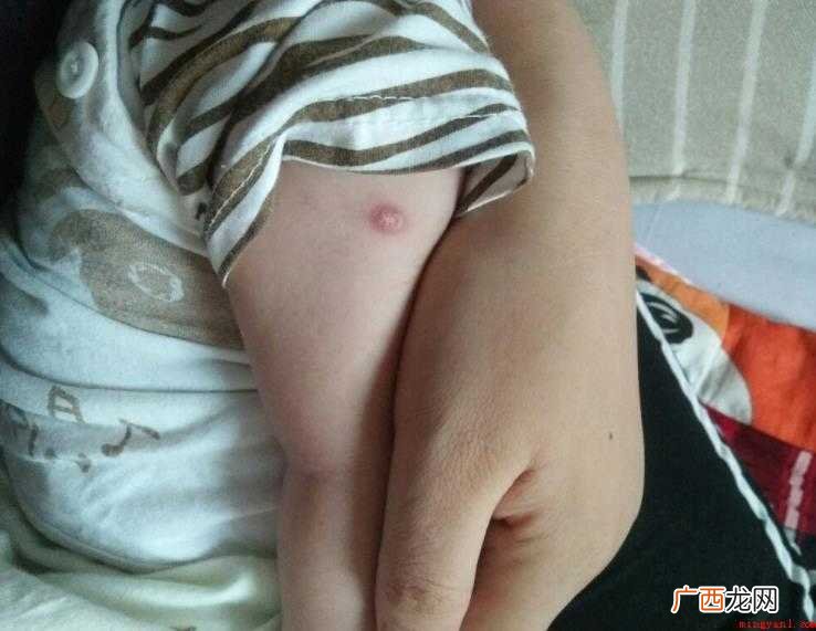 宝宝打疫苗手臂有脓包怎么回事