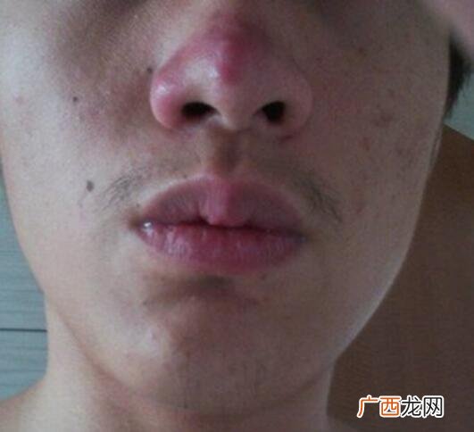 空鼻症是什么,空鼻症原因是什么？