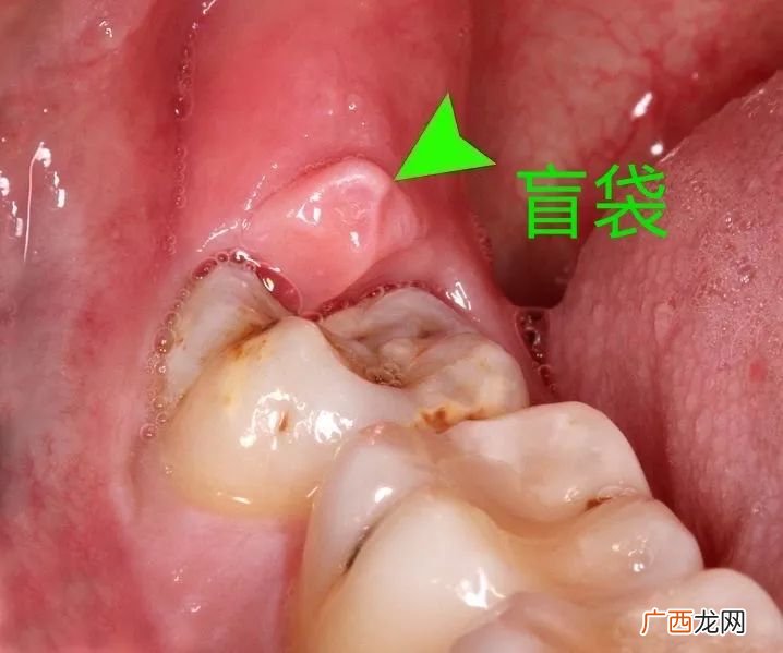 智齿在哪个位置,智齿会长在上面吗？